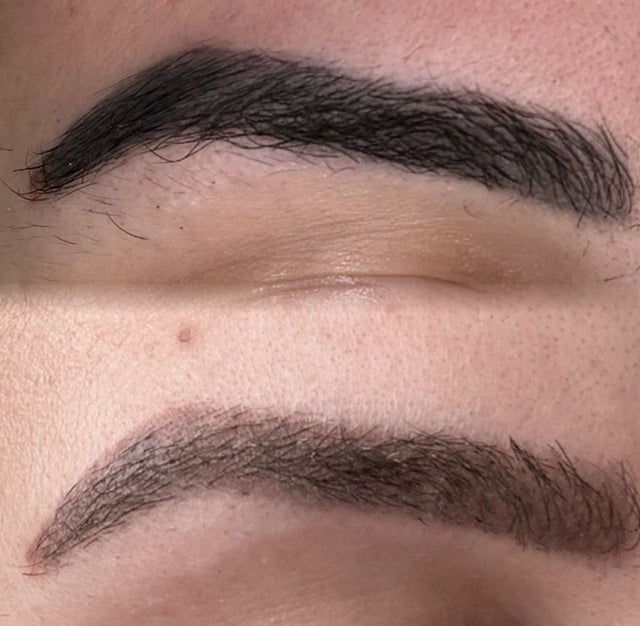 LASER TATTOO REMOVAL